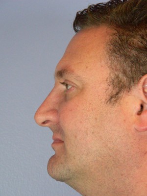 Rhinoplasty Before and After