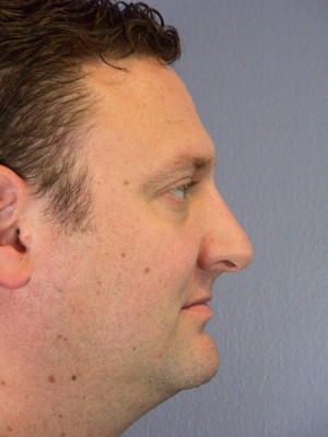 Rhinoplasty Before and After