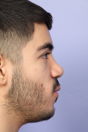 Rhinoplasty Before and After