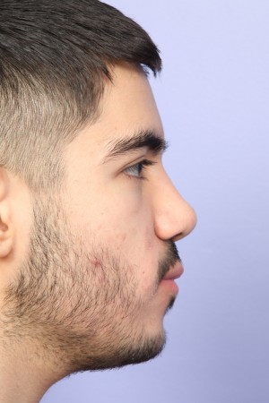 Rhinoplasty Before and After