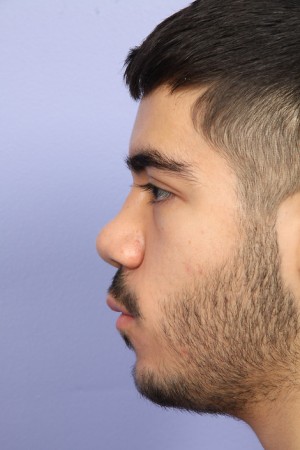 Rhinoplasty Before and After