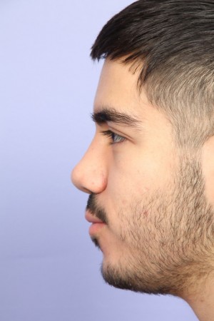 Rhinoplasty Before and After