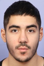 Rhinoplasty Before and After Photo