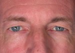 Eyelid Surgery Before and After Photo