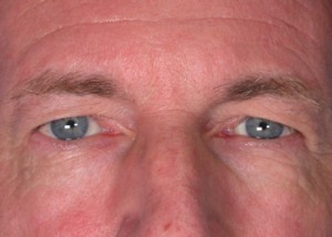 Eyelid Surgery Before and After