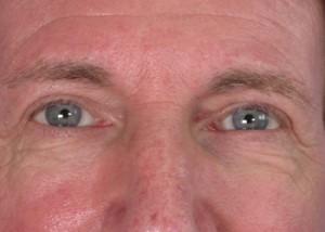 Eyelid Surgery Before and After