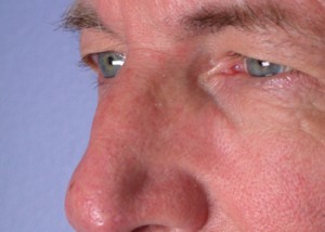 Eyelid Surgery Before and After