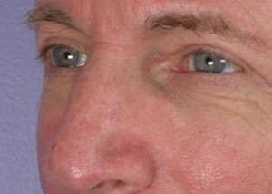 Eyelid Surgery Before and After