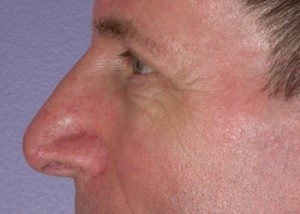 Eyelid Surgery Before and After