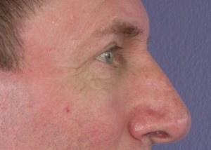 Eyelid Surgery Before and After