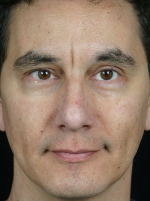 Skin Resurfacing Before and After