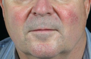 Skin Resurfacing Before and After