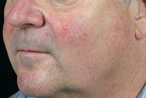 Skin Resurfacing Before and After