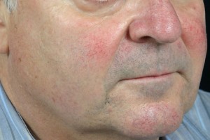 Skin Resurfacing Before and After