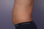 CoolSculpting Before and After Photo