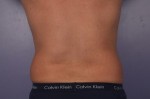 CoolSculpting Before and After Photo