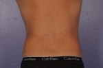 CoolSculpting Before and After Photo