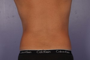 CoolSculpting Before and After