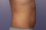 CoolSculpting Before and After Photo