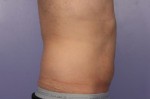 CoolSculpting Before and After Photo