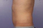 CoolSculpting Before and After Photo