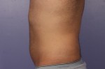 CoolSculpting Before and After Photo