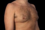 CoolSculpting Before and After Photo