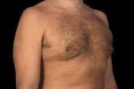 CoolSculpting Before and After Photo