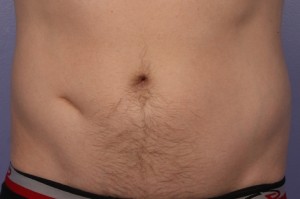 CoolSculpting Before and After