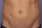 CoolSculpting Before and After Photo