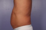 CoolSculpting Before and After Photo