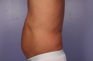 CoolSculpting Before and After