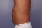 CoolSculpting Before and After Photo