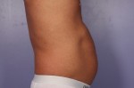 CoolSculpting Before and After Photo