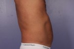 CoolSculpting Before and After Photo