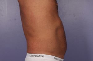 CoolSculpting Before and After