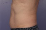 CoolSculpting Before and After Photo