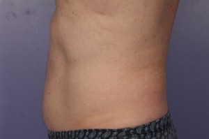 CoolSculpting Before and After