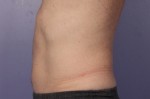 CoolSculpting Before and After Photo