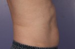 CoolSculpting Before and After Photo