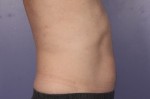 CoolSculpting Before and After Photo