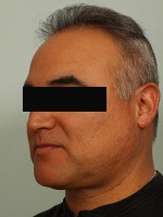 NeoGraft Before and After Photo