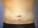 CoolSculpting Before and After Photo