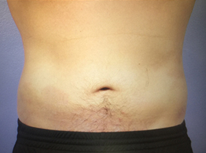 CoolSculpting Before and After