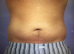 CoolSculpting Before and After Photo