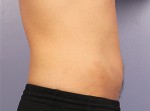 CoolSculpting Before and After Photo