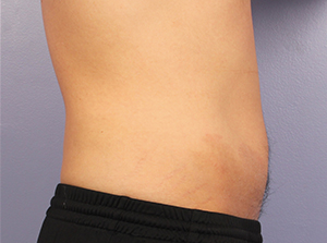 CoolSculpting Before and After