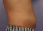 CoolSculpting Before and After Photo