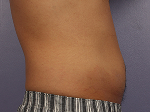 CoolSculpting Before and After