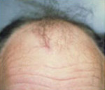 NeoGraft Before and After Photo